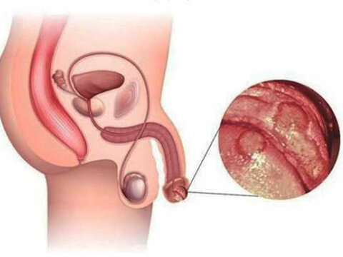 Молочница (кандидоз) у мужчин