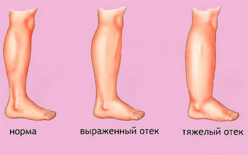 Что такое отек?