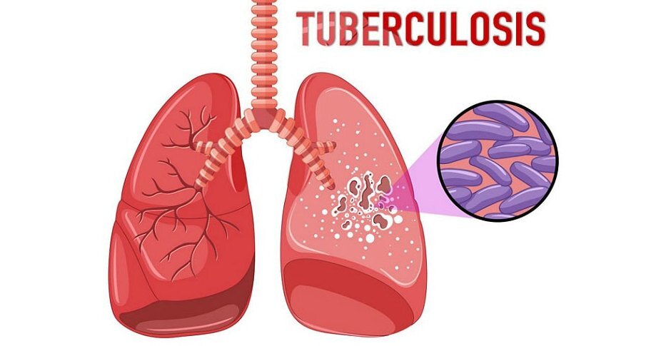 Лучевая диагностика туберкулёза
