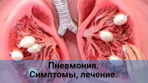 Пневмония. Симптомы, лечение.