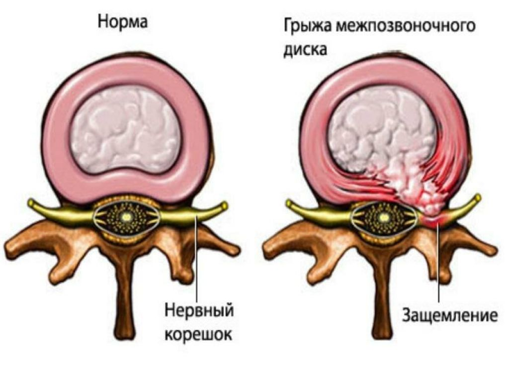 Снижение высоты межпозвоночных дисков