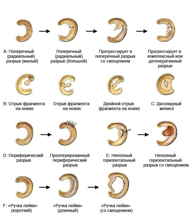 Признаки дегенеративных изменений менисков