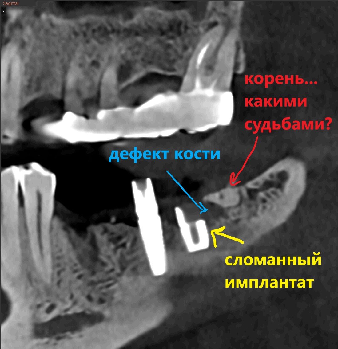 Хотите костей покрепче? А бонусом перелом имплантата. Почему у плотной  кости больше рисков? | Parodoctor | Дзен