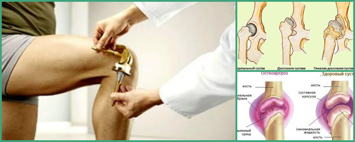 Эндопротезирование тазобедренного, коленного сустава - Клиника Здоровье г. Екатеринбург