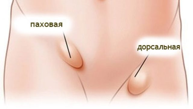 Бедренная грыжа — Лечение грыжи живота, операция, удаление грыжи в Киеве - Хирург Рейзин Денис