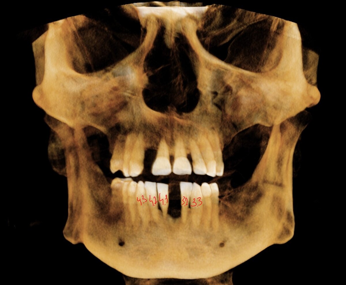 3Д визуализация костей черепа и зубов.