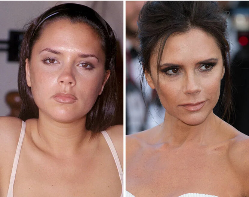 Виктория Бэкхэм до и после удаления комков Биша