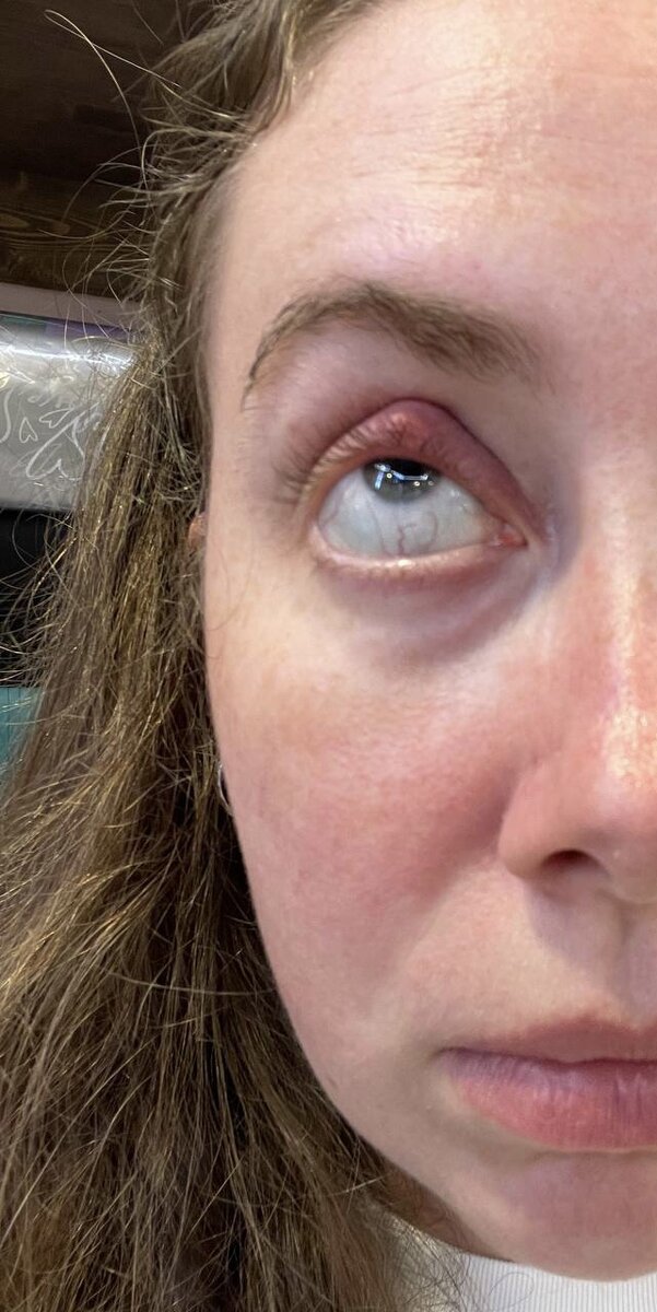 Размер халязиона до приема ЦИФРАН СТ 