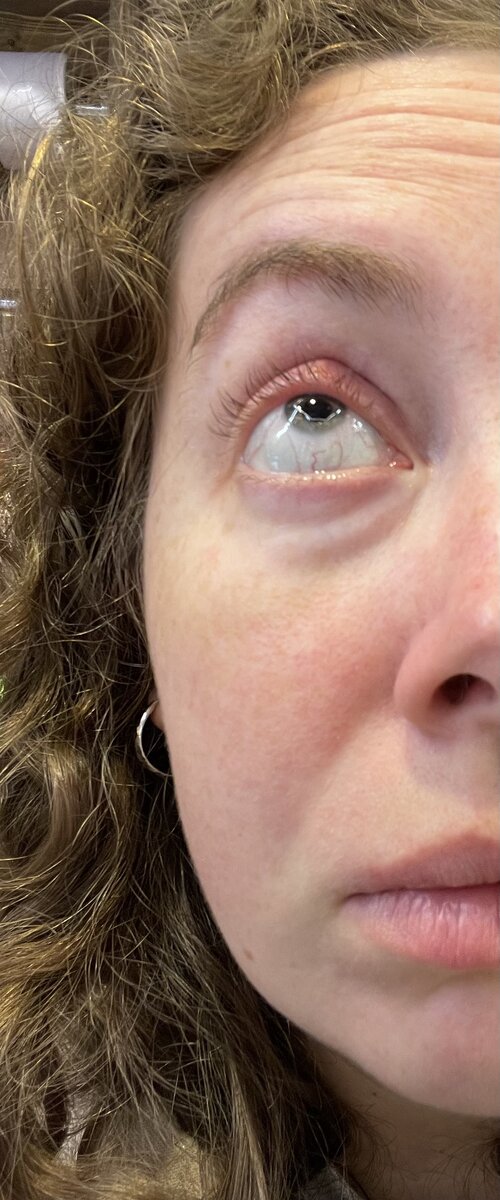 Халязион после приема двух таблеток ЦИФРАН СТ 