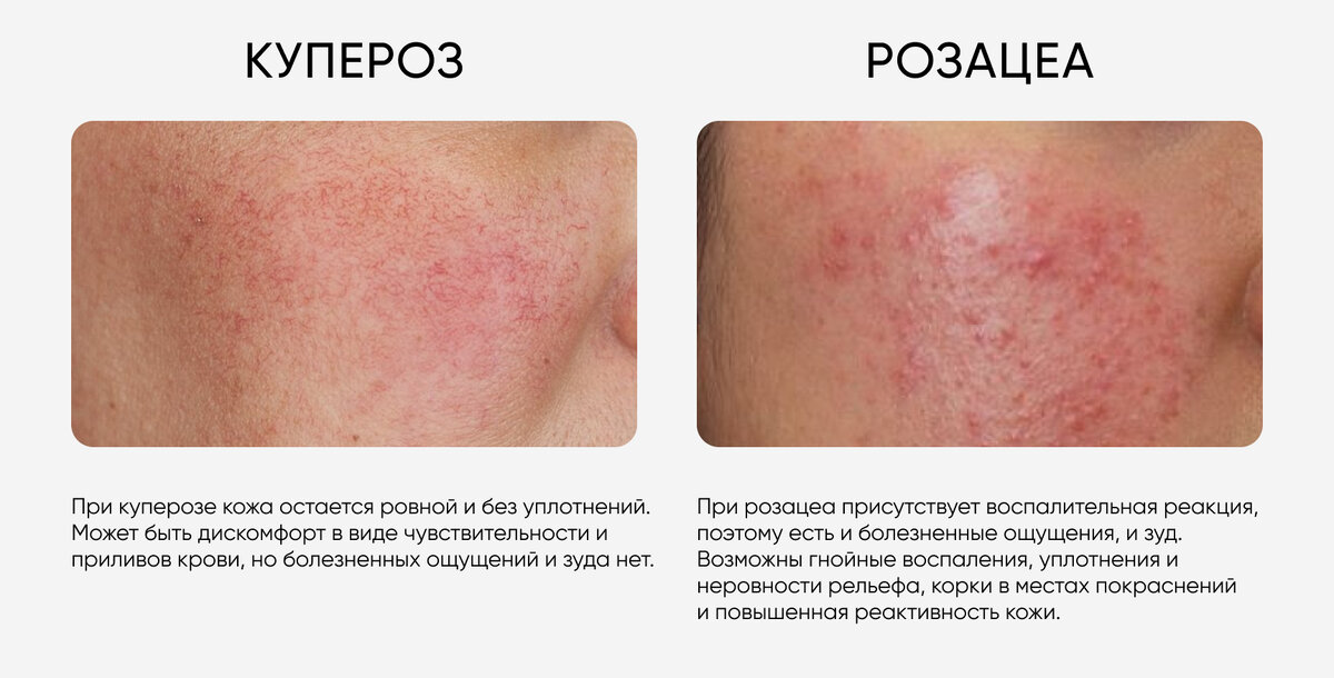 Купероз и розацеа на лице: отличия, лечение, подбор ухода | ICON SKIN ...