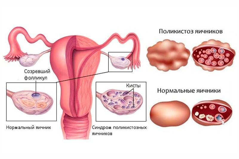 Овуляторный синдром