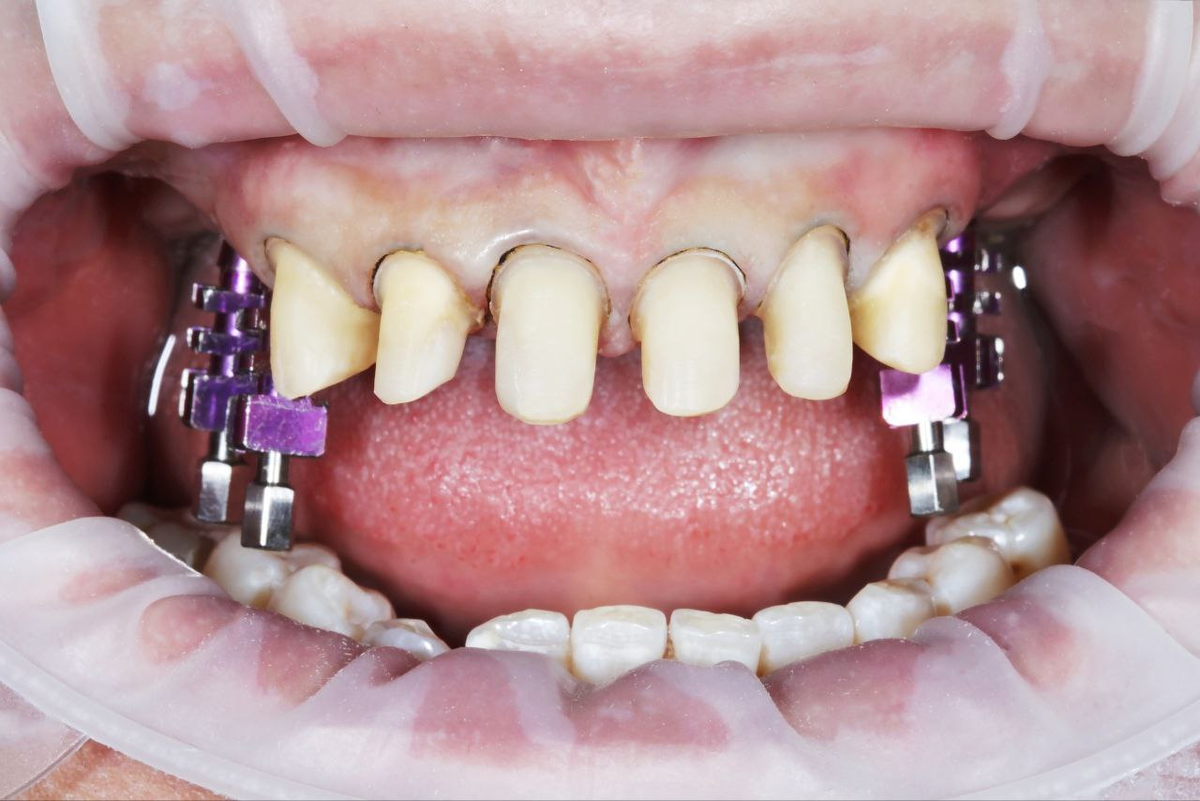 Больше всего пациентов пугает обточка зубов. В статье вы узнаете и о ней.