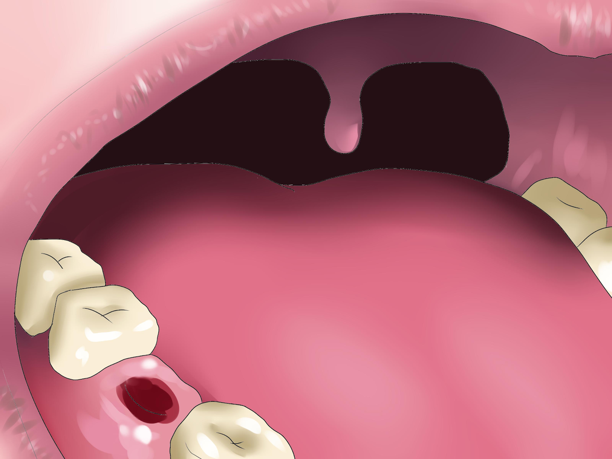 Как заживает лунка после удаления зуба? | Стоматология ROOTT | Дзен