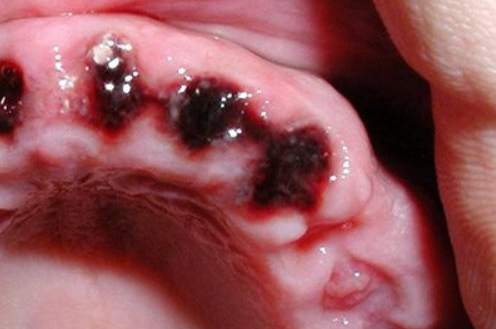 Заживление после удаления зуба — норма и осложнения