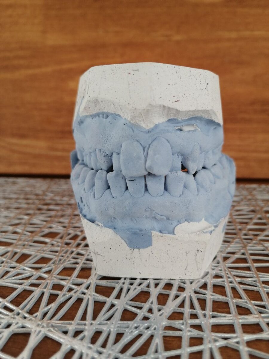 после окончания ортодонтического лечения первоначальный слепок челюсти мне предложили забрать в качестве сувенира))))
