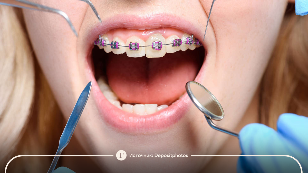 Исправление прикуса — это не только вопрос эстетики, но и здоровья в целом. От положения зубов зависит наше дыхание, симметрия лица и даже осанка.