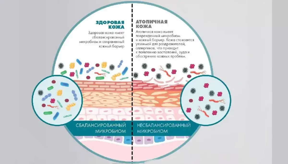 Biome пробиотик. Микробиом и микробиота кожи. Микробиом атопический дерматит. Нормальная микрофлора кожи. Микрофлора кожи здорового человека.