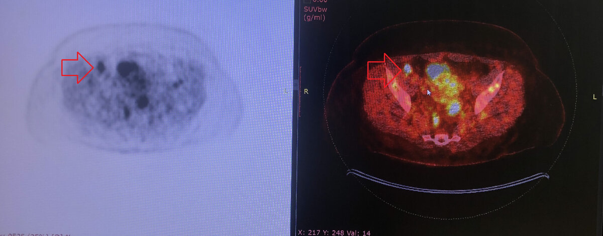ПЭТ-КТ. Стрелками указан подозрительный лимфоузел (SUVmax 8,83)