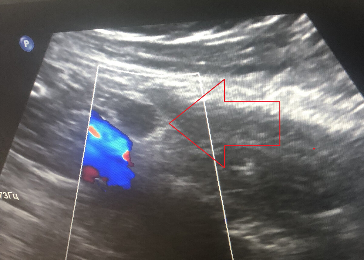  Узел был расположен чуть выше крупных наружных подвздошных сосудов