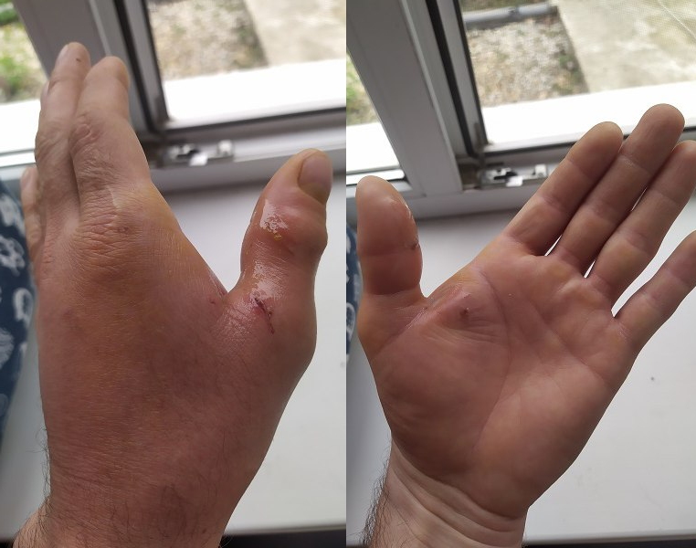 Надутая рука