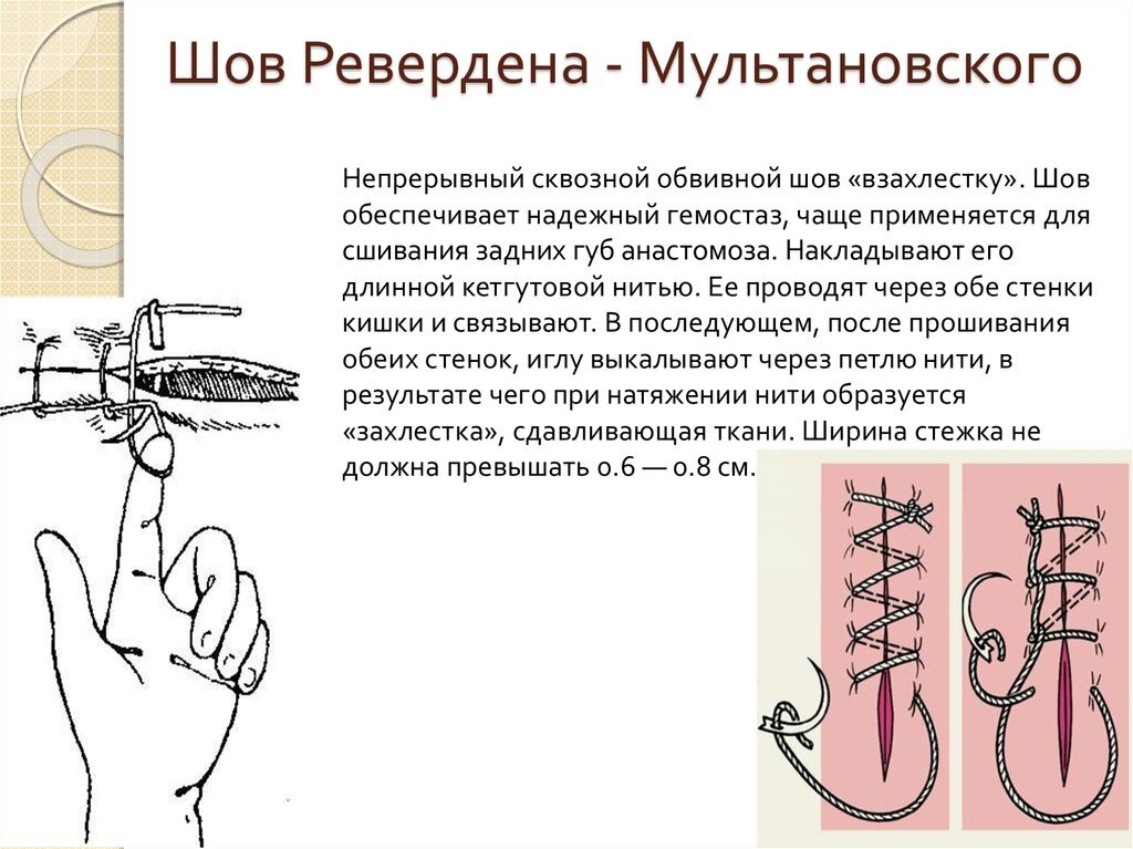 Как правильно снимать хирургические швы