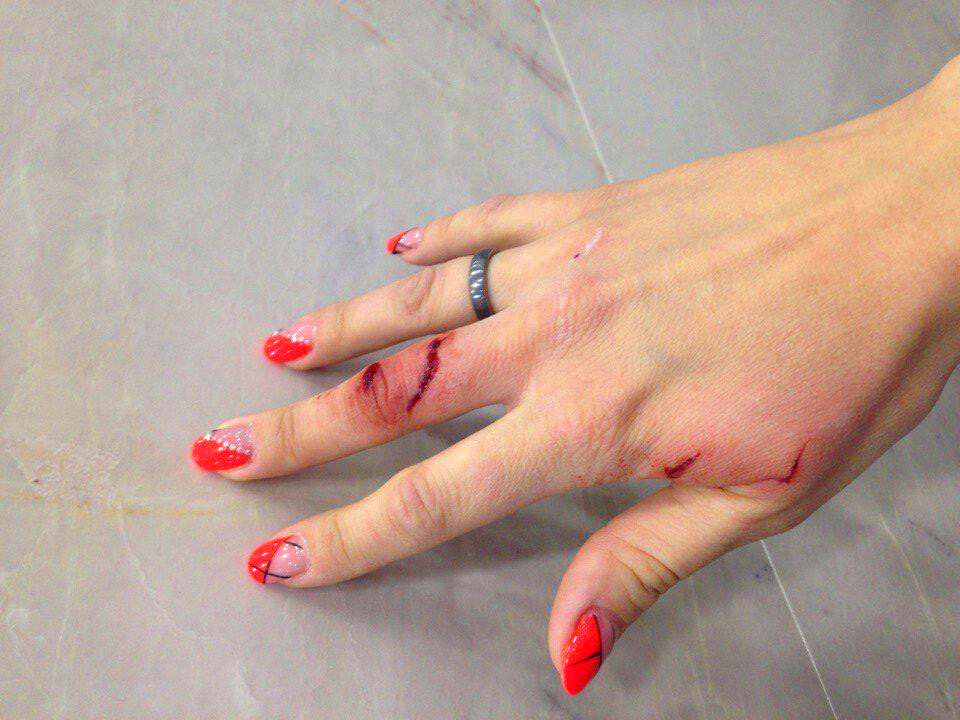 Примерно такие шрамы может оставить щука. Фото из интернета.