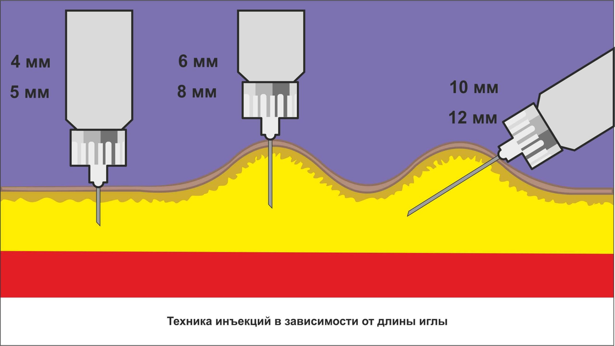Что означает колоть. Техника подкожного введения инсулина шприцом. Введение инсулина подкожно шприц ручкой. Длина иглы для инсулина. Техника введения инсулина подкожно шприц ручкой.