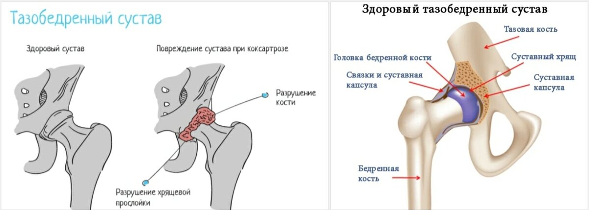 Тендиноз тазобедренного сустава что. Тазобедренный сустав схема. Вертельная сумка тазобедренного сустава. Строение тазобедренного сустава. Тазобедренный сустав рисунок.