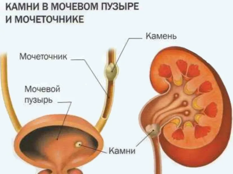 Камни выходят через мочеточник. Мочекаменная болезнь мочевого пузыря. Камни в почках мочеточнике и мочевом пузыре. Почка камень в мочеточнике. Мочеполовой системы - мочекаменная болезнь.