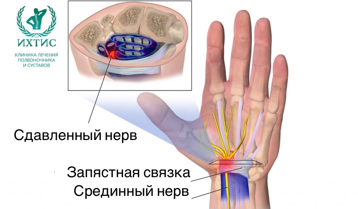  Синдром запястного канала Синдром запястного канала возникает из-за давления на срединный нерв.