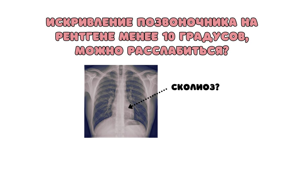 Искривление позвоночника на рентгене менее 10 градусов, можно расслабиться?  | Сколио центр | Дзен