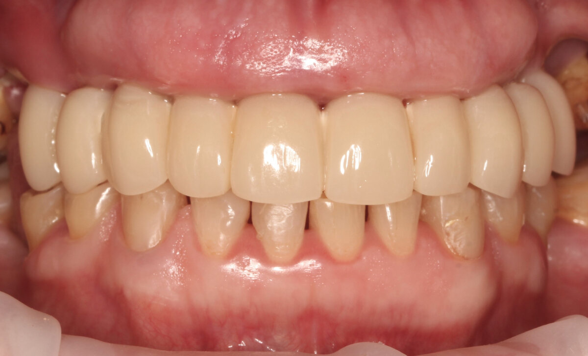 В будущем можно провести операцию и воссоздать межзубные сосочки. Но пациентка довольна, она не хочет улучшений) Её право. 