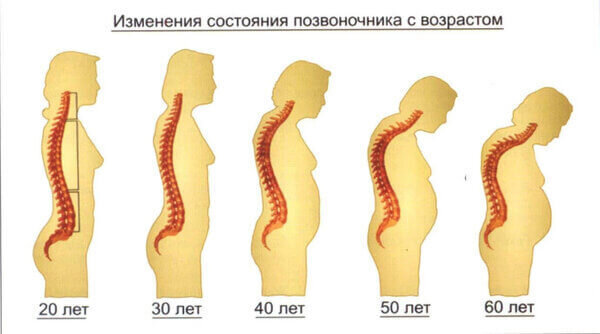 Грудь и второй подбородок - это не только коллаген, но и слабые мышцы спины и деформация осанки. 