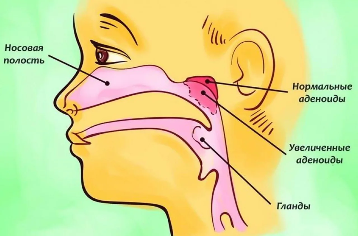 Где аденоиды у ребенка
