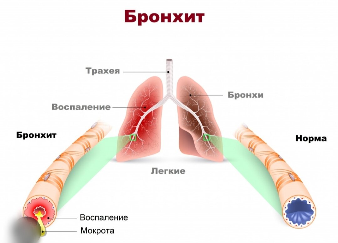 Как без лекарств вылечить насморк и кашель