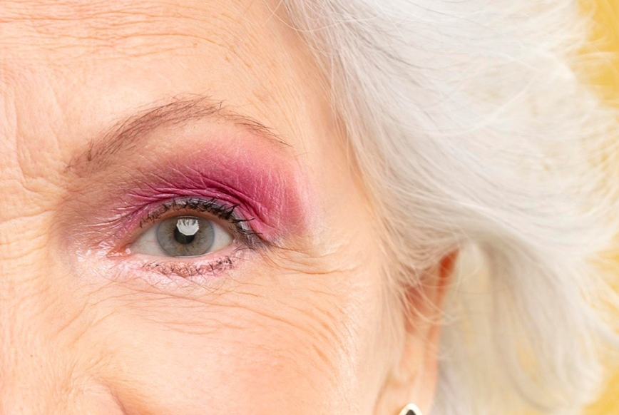 Морщины на нижнем веке подчеркнуты сияющим продуктом