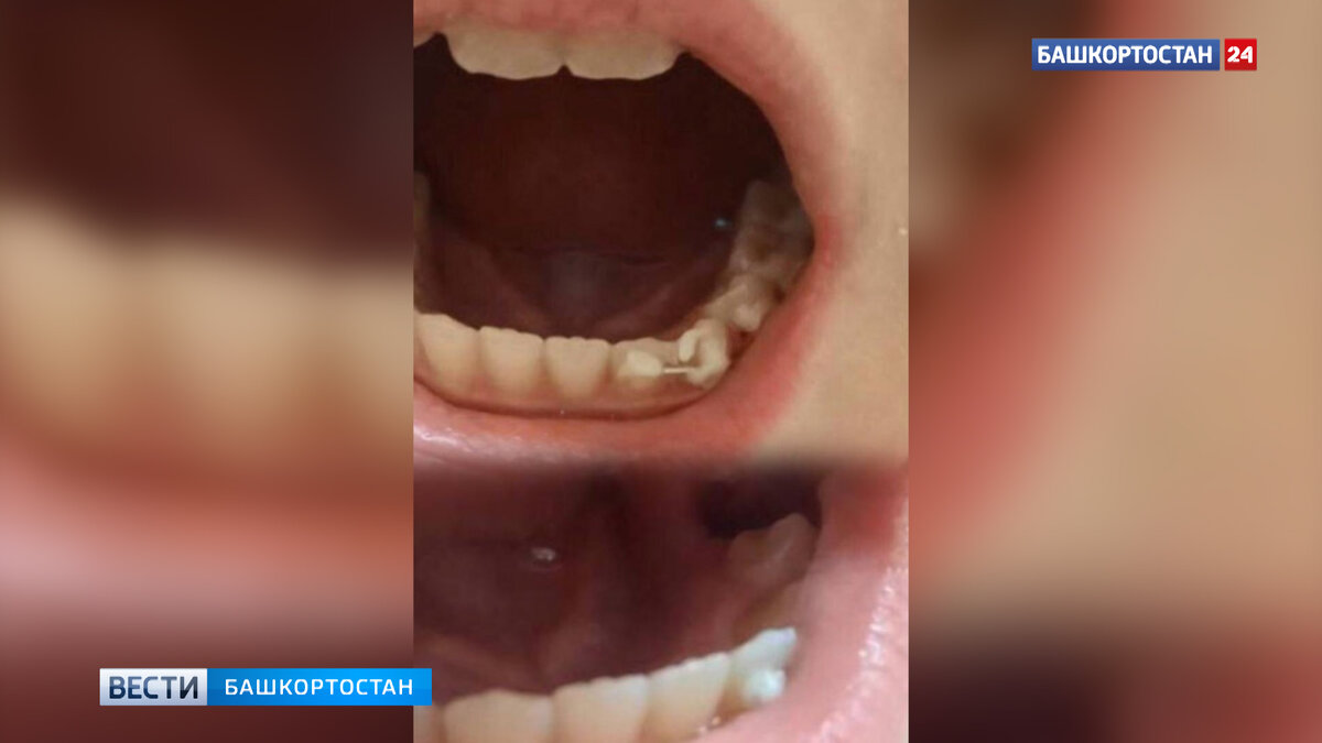    "Не может поесть": мама девочки, которой по ошибке удалили не тот зуб, рассказала о состоянии дочери