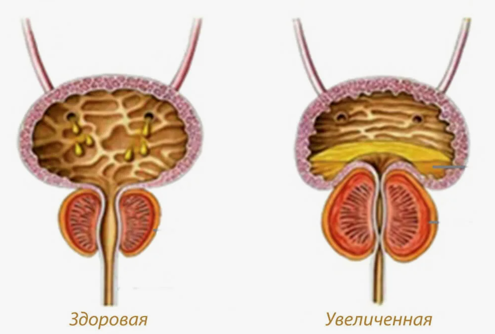 Девочки простата. Предстательная железа аденома простаты. Аденома простаты симптомы. Доброкачественная гиперплазия предстательной железы.