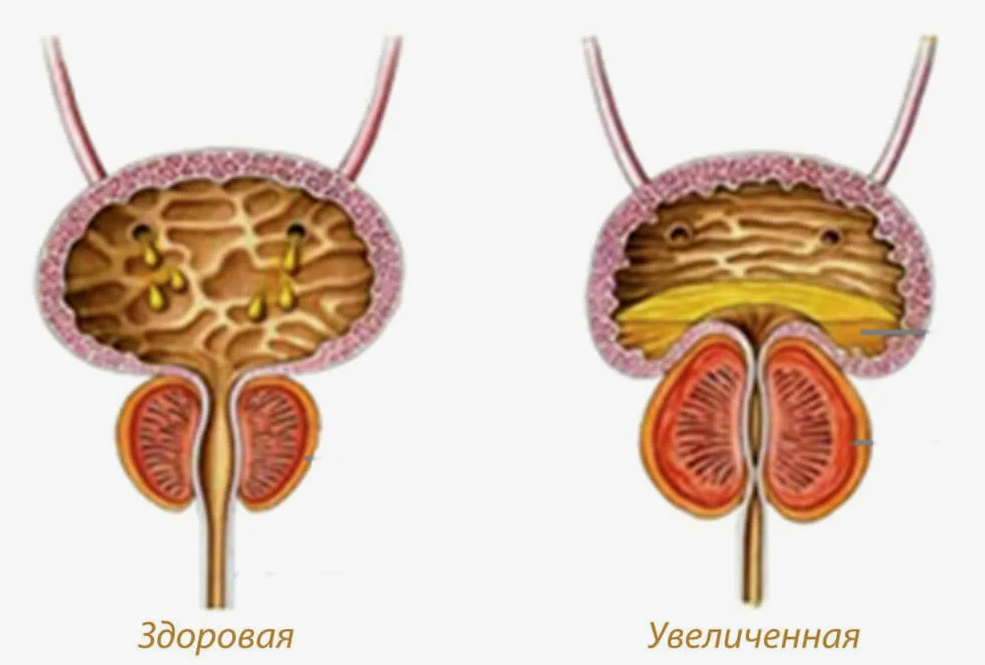 Урок простаты