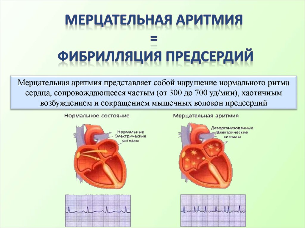 Мерцательная аритмия сердца: лечение, симптомы - СЦЗ
