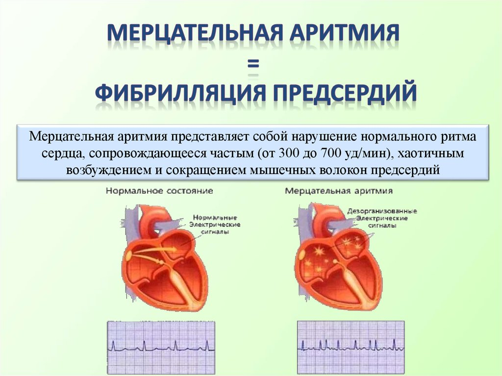 Аритмичные тоны сердца