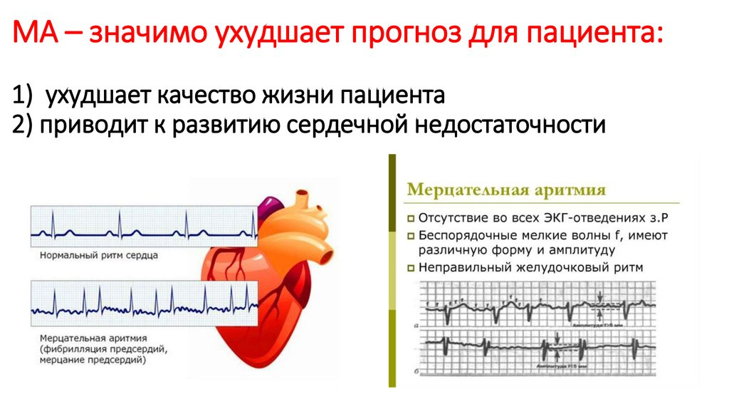 Что такое фибрилляция предсердий простыми словами