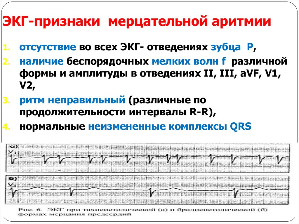 Желудочковые нарушения ритма клинические. Мерцательная аритмия симптомы на ЭКГ. Критерии мерцательной аритмии на ЭКГ. ЭКГ- признаками мерцательной аритмии являются:. Мерцание предсердий на ЭКГ признаки.