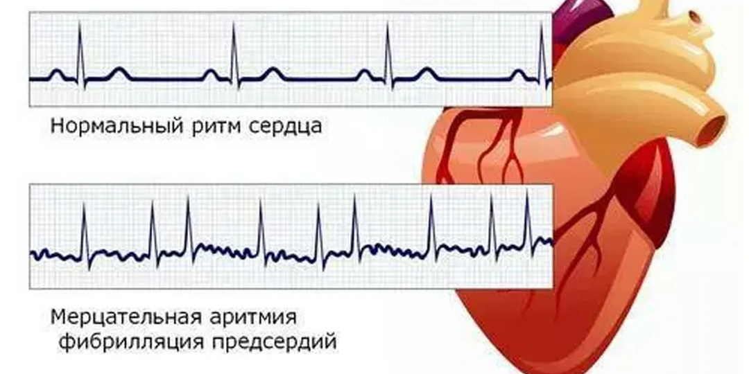 У меня определили мерцательную аритмию – что это такое, чем опасна эта патология