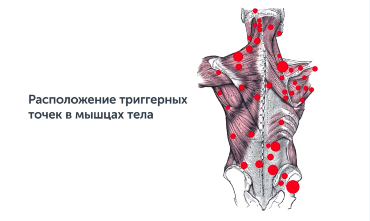 Триггерные точки что это такое. Триггерные точки трапециевидной мышцы. Синдром трапециевидной мышцы. Трапециевидная мышца спины триггерные точки. Триггерная точка воротниковой зоны