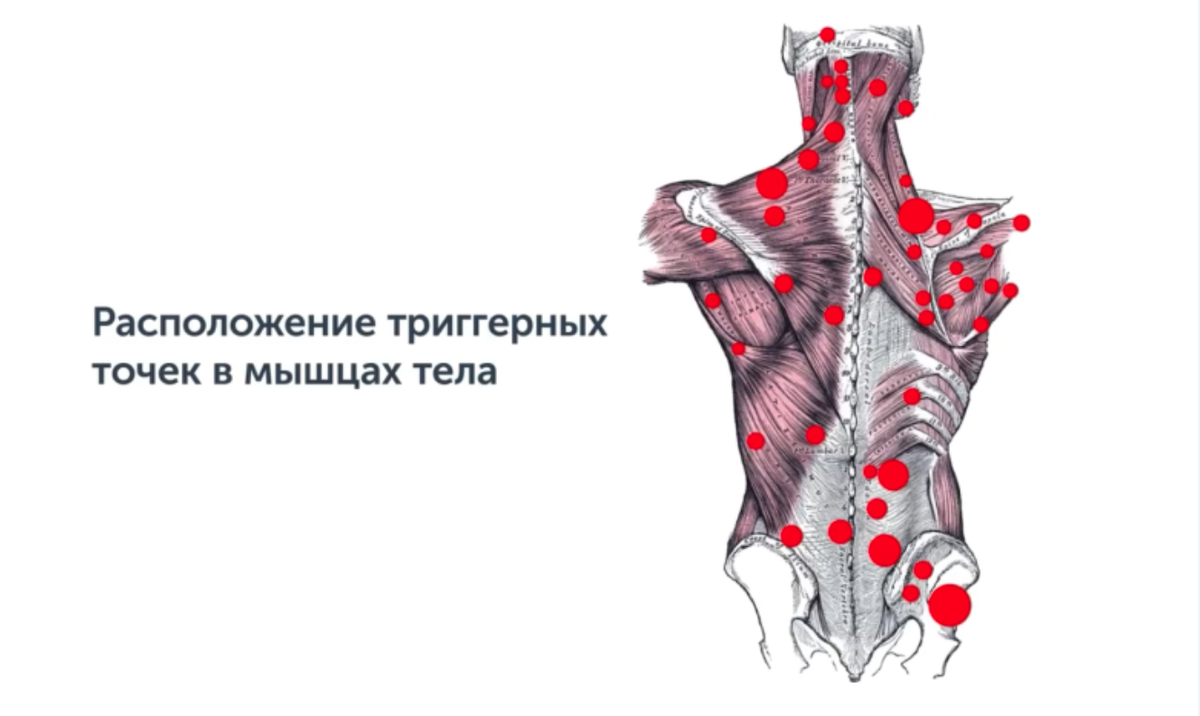 Триггерные точки трапециевидной мышцы. Триггерные точки для задней поверхности шеи.