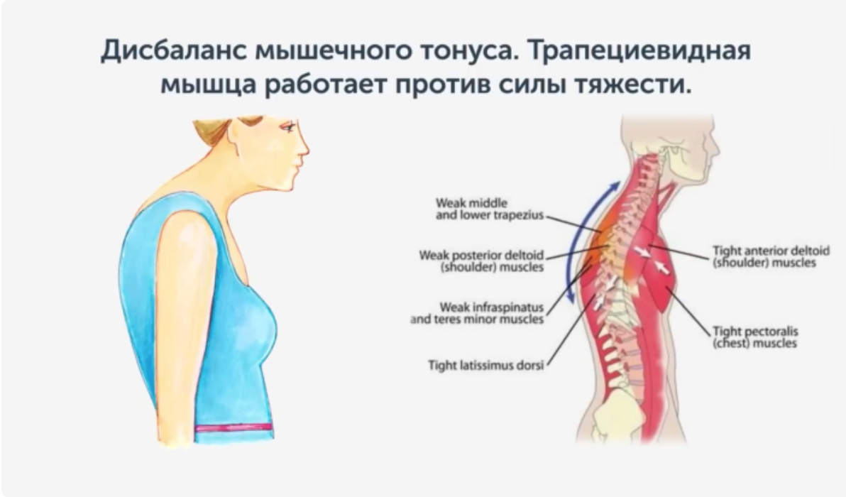 Статические нарушения шейного. Боли мышц в шейно воротниковой зоне. Мышцы воротниковой зоны. Шейно-воротниковая зона массаж схема. Болят мышцы шеи и воротниковой зоны.