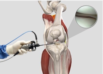 Артроскопическая хирургия, новаторский подход 20 века к операции на суставах, он включает небольшие разрезы и введение крошечной камеры (артроскопа) в сустав.