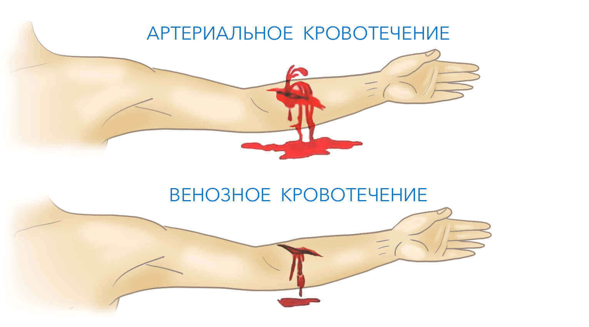 Кровотечения. Виды кровотечения. Способы остановки различных видов  кровотечений. | Медицина.Dr.Dill | Дзен