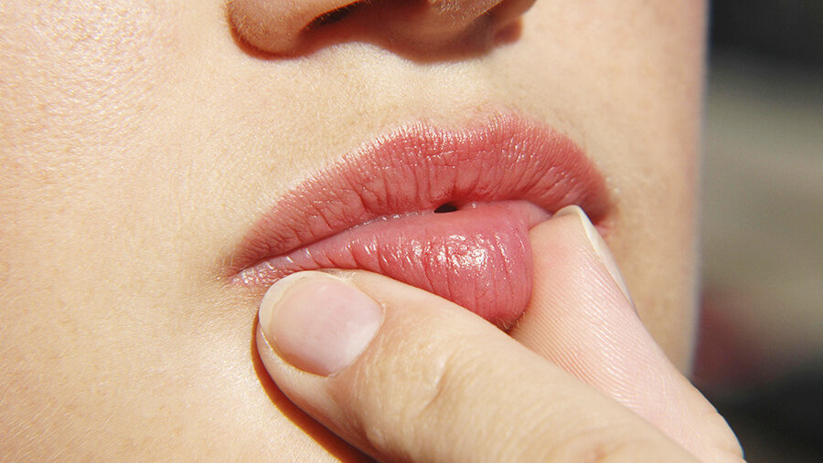 У девушки вылезают губы. Хейлит манганотти эрозия. У девушки вылезают губы. У девушки вылезают губы. У девушки вылезают губы.